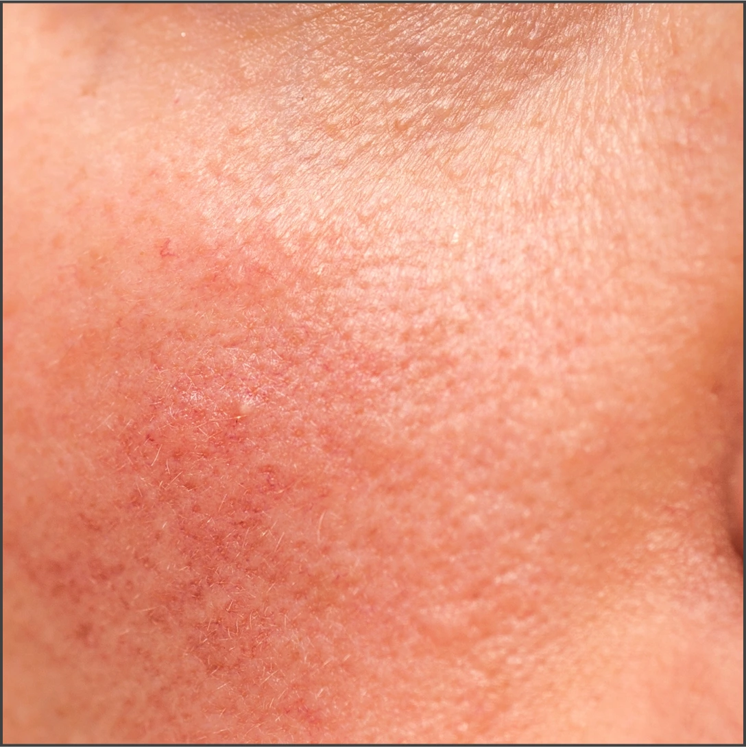 Eczema and redness